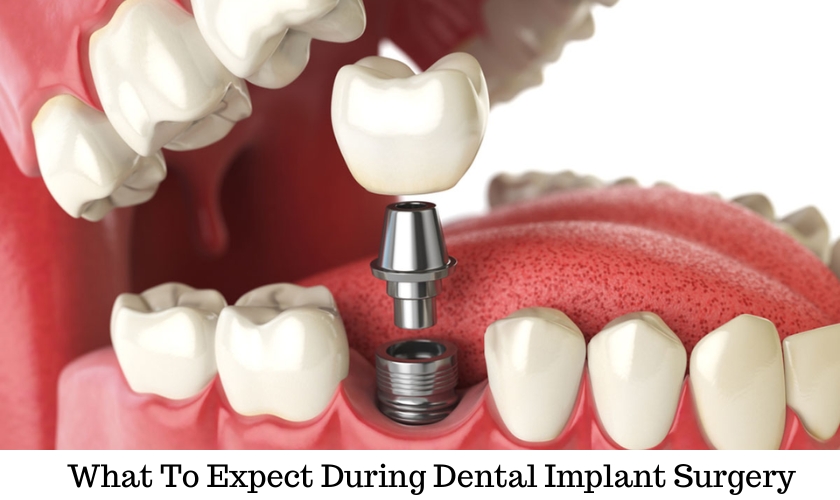 Imafes of what to expect during and following dental implant surgery
