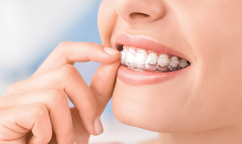 invisalign dentist cypress - 5 benefits of choosing an invisalign dentist for your orthodontic treatment