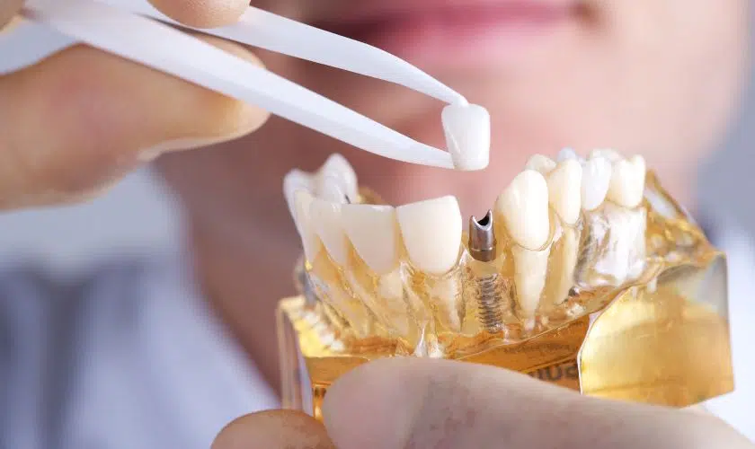 Dental Implants - The Magic Of Christmas Smiles: Enhancing Your Joy With Dental Implants