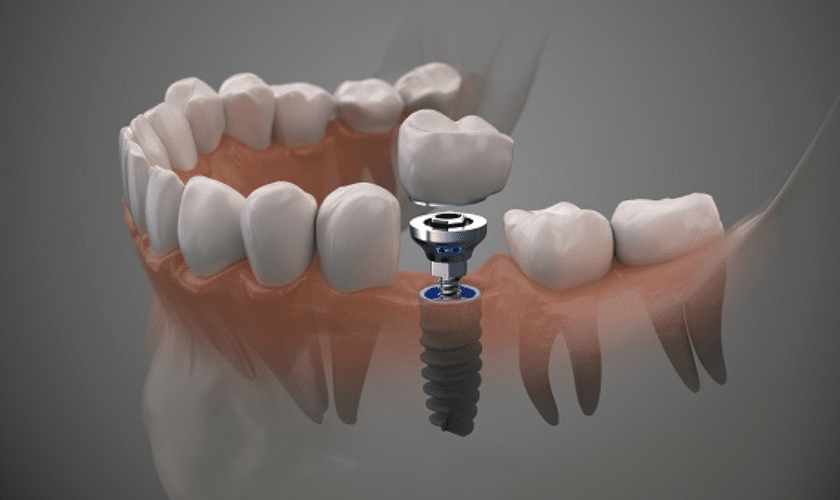 How much time does a tooth implant take
