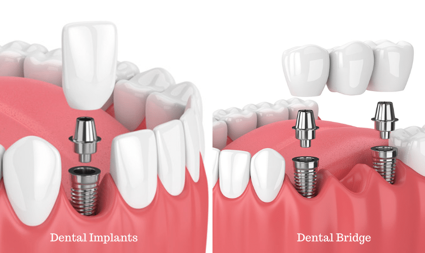 Why Choose A Dental Bridge Over Dental Implants