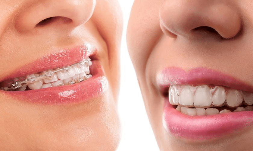 Why Choose Invisalign Over Braces