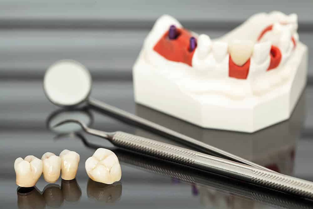 how long do dental crowns last