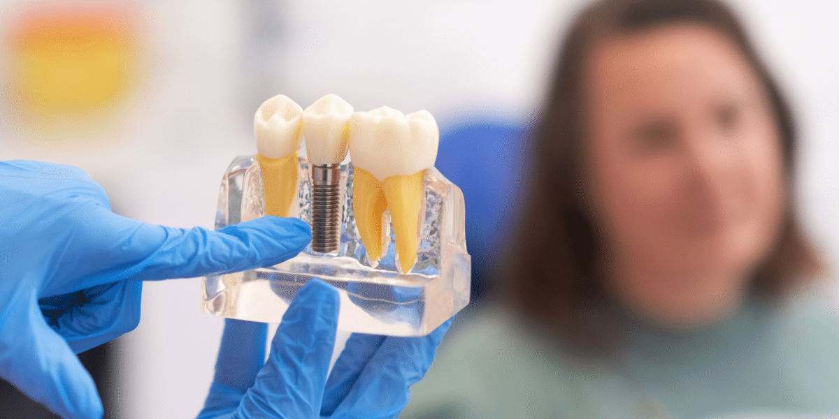dental implants are ideal replacement of missing teeth
