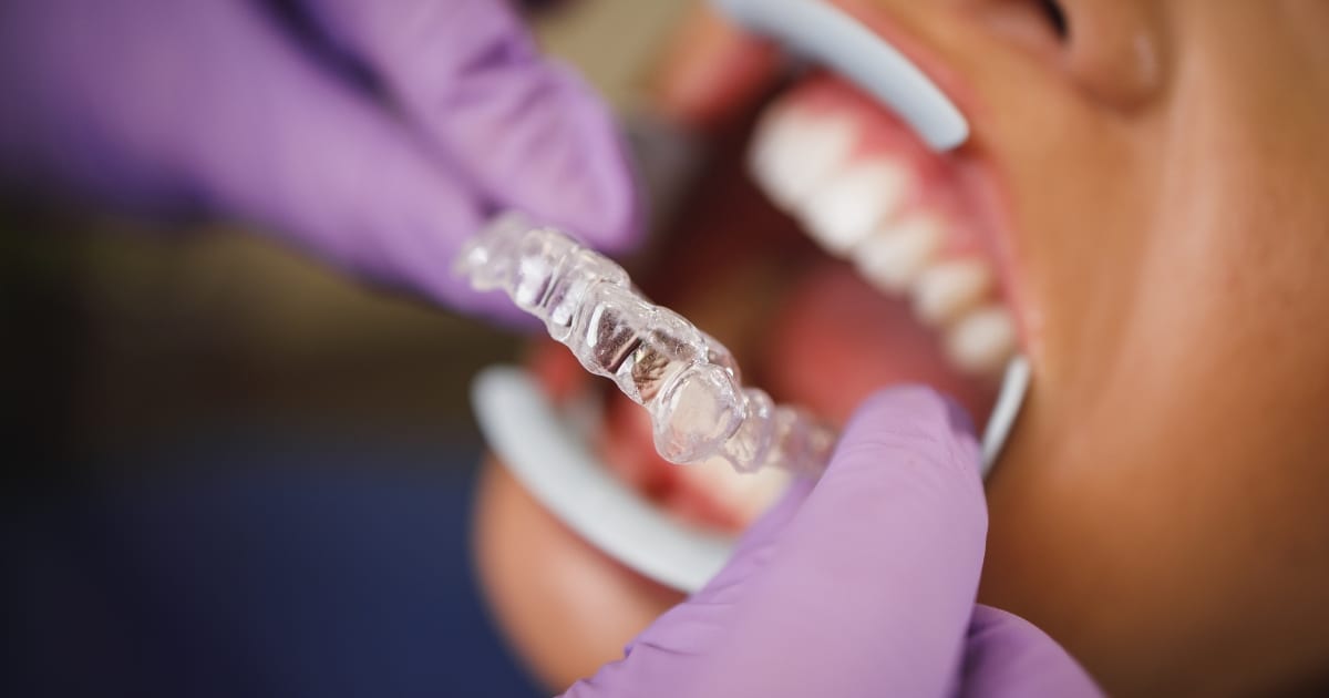 what to do if your invisalign aligner is cutting your gums