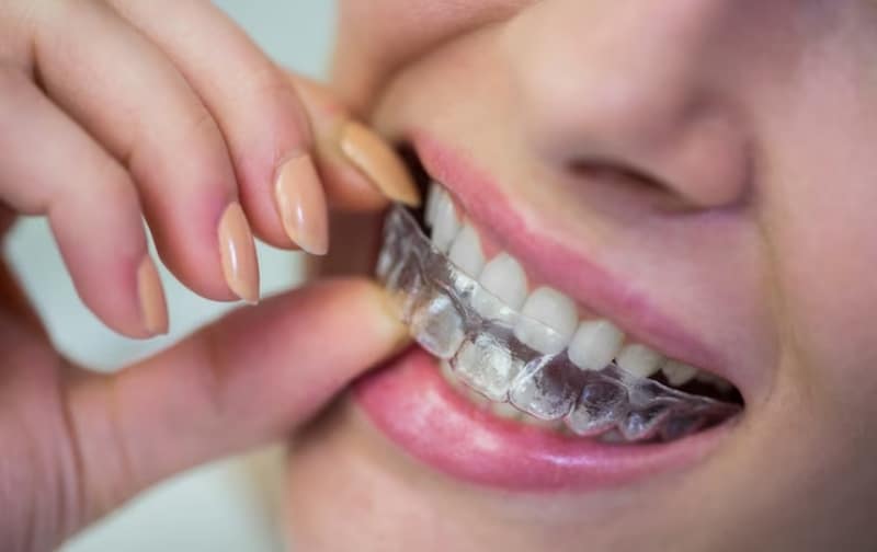 Advantages of Invisalign Beyond Straightening Teeth