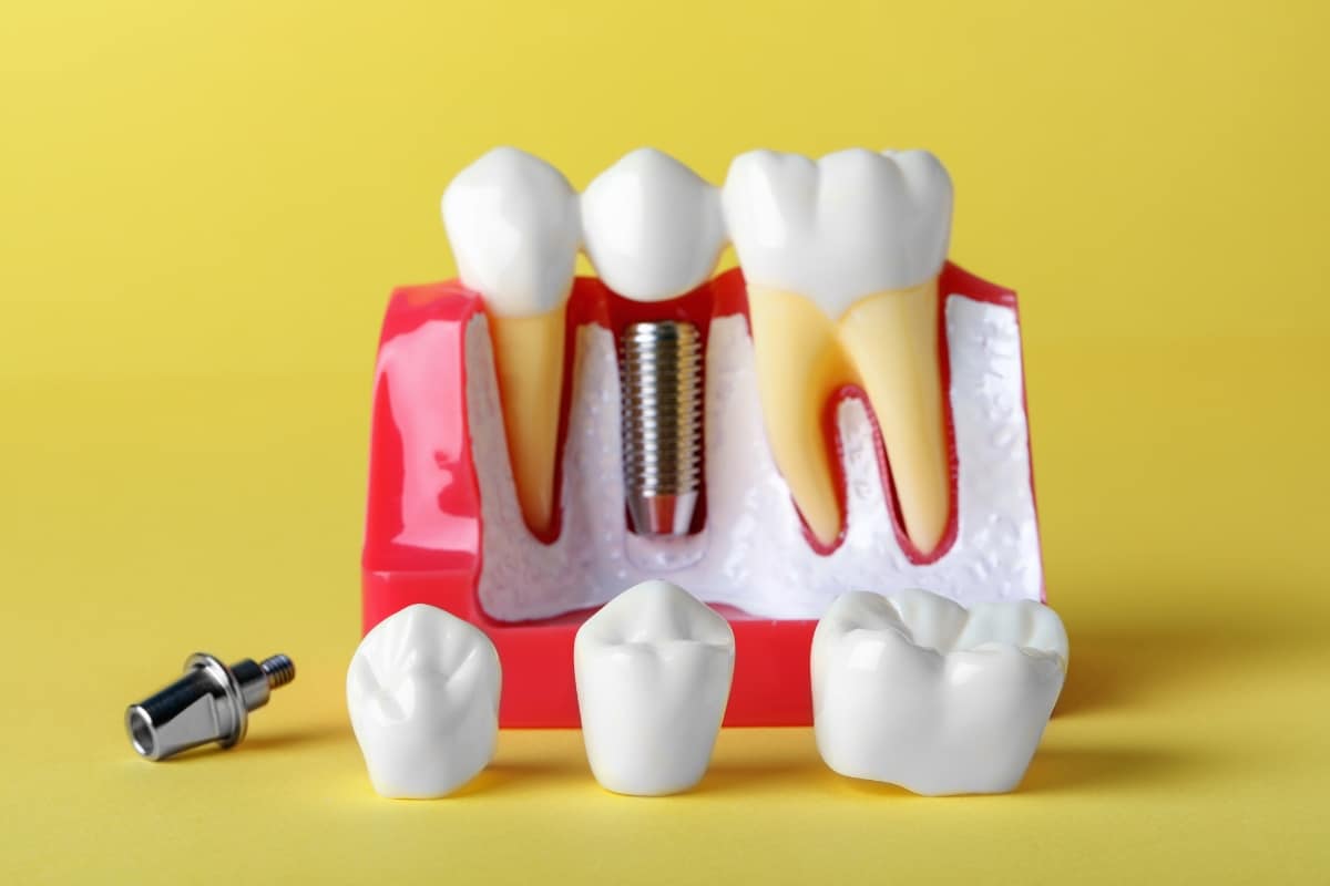 dental implants in Cypress