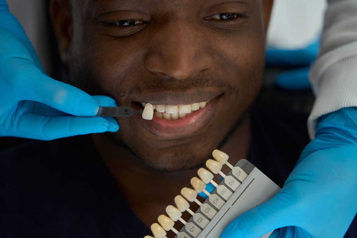 Veneers in Cypress