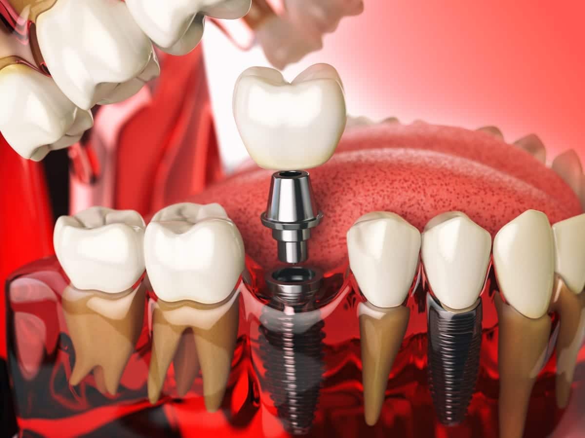 Dental Implants in Cypress
