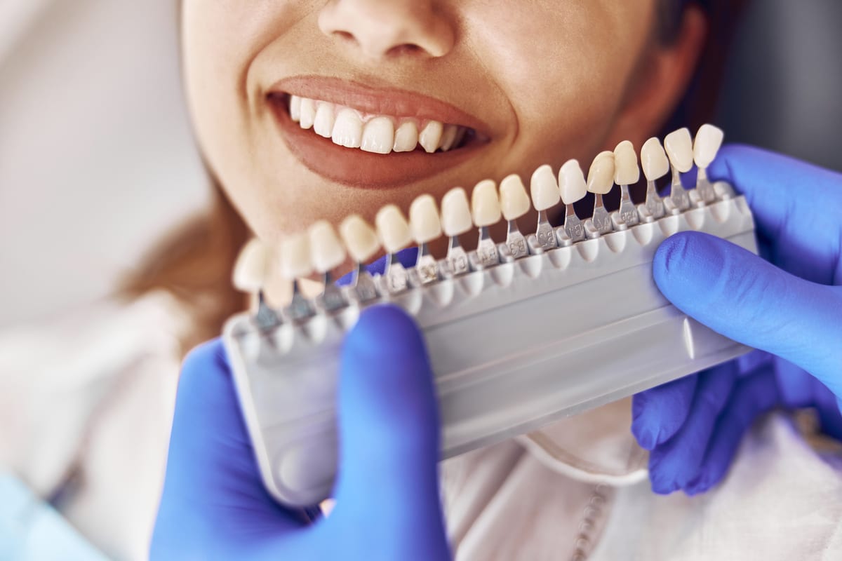 Veneers in Cypress